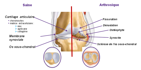 Schema-articulation-saine-vs-arthrosique.PNG